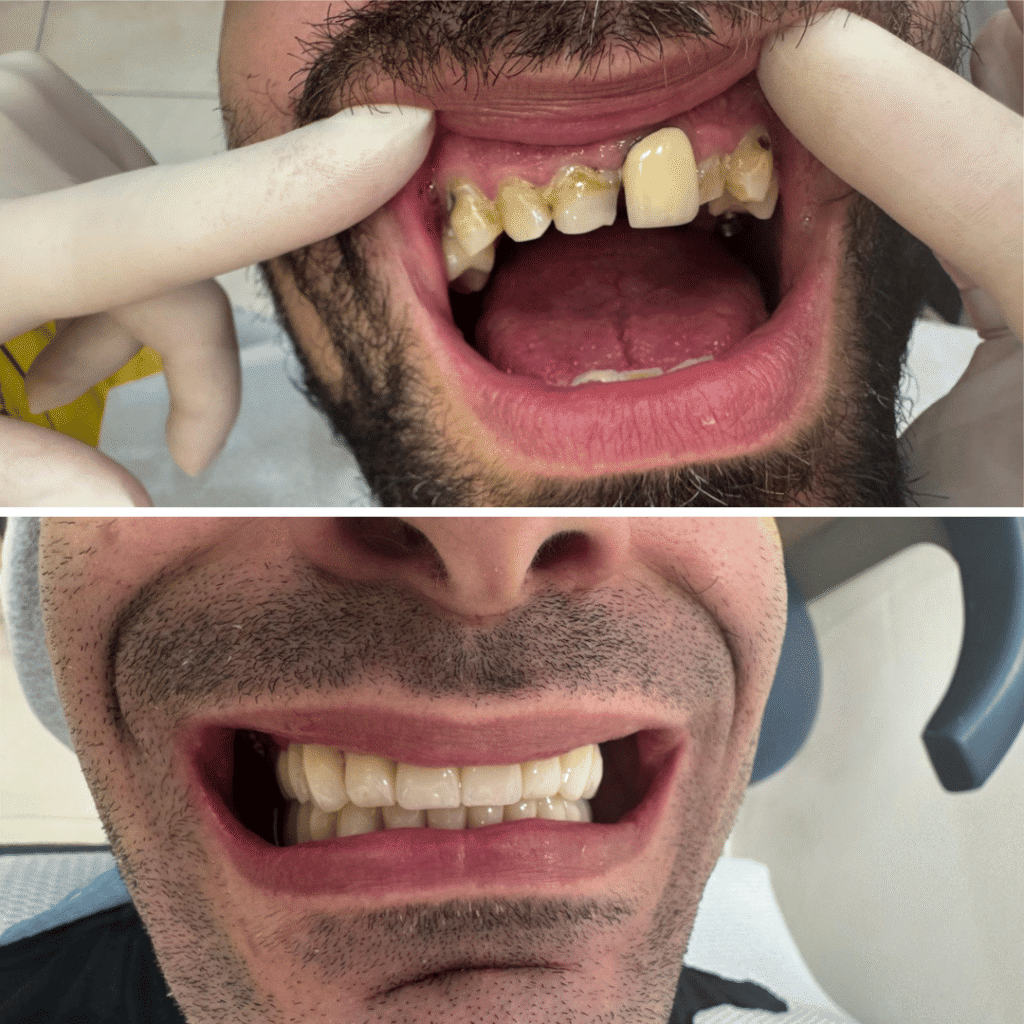 לפני אחרי כתרי זירקוניה